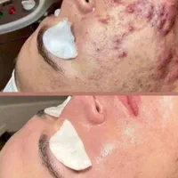 پاکسازی پوست،مطب سوپر فشیال تخصصی اقایان و بانوان|خدمات آرایشگری و زیبایی|تهران, نارمک|دیوار