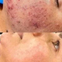 فیشیال تخصصی پوست|خدمات آرایشگری و زیبایی|سبزوار, فرهنگیان|دیوار