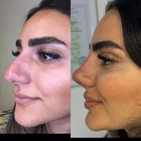 لیفت بینی بانخ