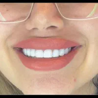 دست دندان مصنوعی طرح لمینیت|خدمات آرایشگری و زیبایی|تهران, تهرانپارس غربی|دیوار