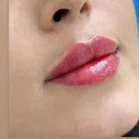 ژل /بوتاکس فیلر لب روسی اموزش بوتاکس آنزیم چربی|خدمات آموزشی|خرم‌آباد, |دیوار