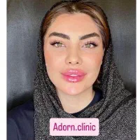 مدل فیلر لب روسی،کانتورینگ صورت،زاویه،چانه وشقیقه|خدمات آرایشگری و زیبایی|تهران, صادقیه|دیوار