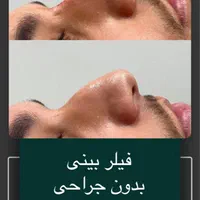 ژل لب روسی وعروسکی از ۸۰۰ ،بوتاکس۷۰۰ پی ارپی۷۰۰|خدمات آرایشگری و زیبایی|مشهد, فلسطین|دیوار