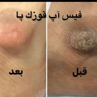 رفع تیرگی بدن در مطب پزشکی با دستگاه|خدمات آرایشگری و زیبایی|شیراز, قدوسی غربی|دیوار