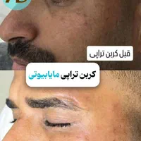 روشن کننده صورت بیکینی ،کربن تراپی تخصصی مابیوتی|خدمات آرایشگری و زیبایی|یاسوج, |دیوار