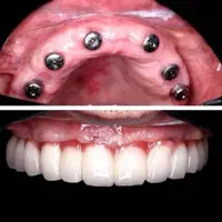 دندانپزشکی ایمپلنت اوردنچر روکش  تخصصی شمال غرب|خدمات آرایشگری و زیبایی|تبریز, |دیوار