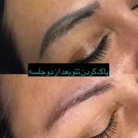 حذف تتو قدیمی.کربن تراپی با لیزر کیوسوییچ|خدمات آرایشگری و زیبایی|شیراز, فرهنگ شهر|دیوار