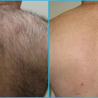 لیزر موهای زائد|خدمات آرایشگری و زیبایی|چالوس, |دیوار