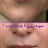 جشنواره تزریق ژل و بوتاکس،فیلرلب،مزو،هایفو،آنزیم|خدمات آرایشگری و زیبایی|کرج, عظیمیه|دیوار