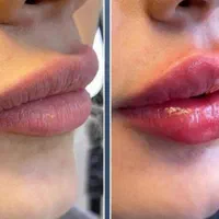 لیزر مو جشنواره. ژل بوتاکس حذف تتو و لک جوانسازی|خدمات آرایشگری و زیبایی|ساری, |دیوار