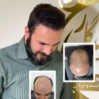 کاشت مو ، تراکم بالا خط رویش طبیعی تضمینی|خدمات آرایشگری و زیبایی|تهران, عباس‌آباد|دیوار