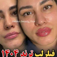 جشنواره عیدانه کلینیک50%تزریق ژللب M بوتاکس لیزر