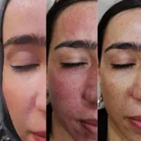 پاک کردن تتو با لیزر (کیوسوییچ)و کربن تراپی|خدمات آرایشگری و زیبایی|مشهد, مهدی آباد|دیوار
