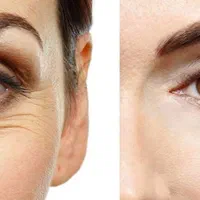 مدل پاکسازی رفع غبغب روشن کننده بیکینی و جراحی|خدمات آرایشگری و زیبایی|تهران, شهرک ولیعصر جنوبی|دیوار