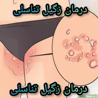 درمان زگیل تناسلی /مشاوره Hpv