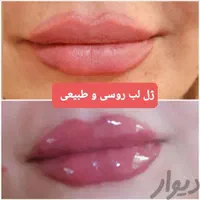 تزریق چربی صورت،ژل،بوتاکس،لیزر،لاغری|خدمات آرایشگری و زیبایی|رشت, گلسار|دیوار