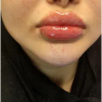 ژل لب و صورت بوتاکس|خدمات آرایشگری و زیبایی|رشت, گلسار|دیوار