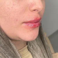 جشنواره فیلر،بوتاکس،پاک کردن تتو بالیزر،خالبرداری|خدمات آرایشگری و زیبایی|اندیشه, اندیشه فاز ۱|دیوار