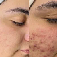کلینیک پوست/درمان لک/جوش جای جوش/مزونیدلینگ/فشیال|خدمات آرایشگری و زیبایی|مشهد, فرهنگ|دیوار