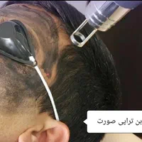 لیزرمو زائد/ریمو تتو/پاک کردن تتو/کیوسوئیچ/prp|خدمات آرایشگری و زیبایی|اصفهان, ملک|دیوار
