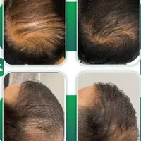 سلول بنیادی برای رویش مجدد و قطع ریزش