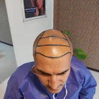کاشت مو،کاشت ابرو، کاشت ریش، بلفاروپلاستی|خدمات آرایشگری و زیبایی|مشهد, کلاهدوز|دیوار
