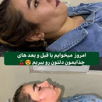 تزریق چربی فیلربادی تزریق ژل در مطب پزشک|خدمات آرایشگری و زیبایی|کرمانشاه, |دیوار