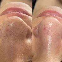 لیزر کک مک خال لیفت لمینت پاکسازی مژه ناخن ژل|خدمات آرایشگری و زیبایی|خرم‌آباد, |دیوار