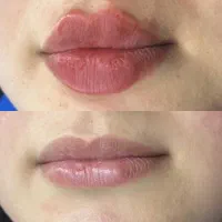 خدمات فیلر زیبایی ،فیشیال تخصصی ،هایفوتراپی|خدمات آرایشگری و زیبایی|زاهدان, |دیوار