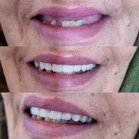 دندانسازی(بلوارهدایت)دندان مصنوعی/دندان سازی|خدمات آرایشگری و زیبایی|مشهد, هدایت|دیوار