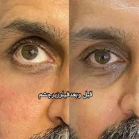 تخفیف ویژه فیلرلب،ژل،انزیم لب،بوتاکس،پی ار پی|خدمات آرایشگری و زیبایی|بندرعباس, |دیوار