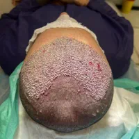 خدمات زیبایی کاشت مو|خدمات آرایشگری و زیبایی|یاسوج, |دیوار