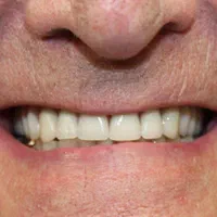 دندان،دندانسازی،اقساطی،دندان مصنوعی،تخفیف|خدمات آرایشگری و زیبایی|مشهد, وکیل‌آباد|دیوار