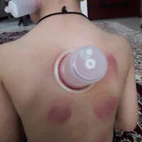 حجامت وبادکش|خدمات آرایشگری و زیبایی|ماهدشت, |دیوار