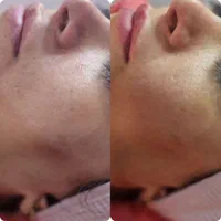 آموزش وخدمات فیشال تخصصی و پرسینگ و برداشتن خال|خدمات آرایشگری و زیبایی|تهران, فلاح|دیوار