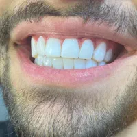 کامپوزیت دندان|خدمات آرایشگری و زیبایی|اسلام‌شهر, شهرک مهدیه|دیوار