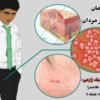 بهبود. زگیل تناسلی