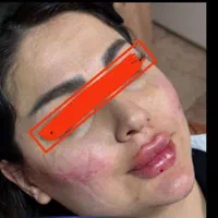 تخفیف ویژه پی ار پیprpفیلرژل بوتاکس کامپوزیت|خدمات آرایشگری و زیبایی|اهواز, کیان اباد|دیوار
