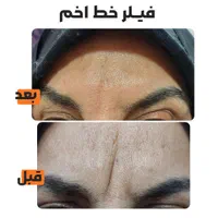 فیلر چروک های صورت|خدمات آرایشگری و زیبایی|شوش, |دیوار