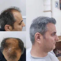 کاشت ابرو وموی طبیعی|خدمات آرایشگری و زیبایی|بوشهر, |دیوار