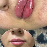 تزریق ژل و بوتاکس در شرق تهران|خدمات آرایشگری و زیبایی|تهران, نظام‌آباد|دیوار