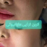 روشن کننده صورت بیکینی ،کربن تراپی تخصصی مابیوتی|خدمات آرایشگری و زیبایی|یاسوج, |دیوار