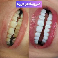 کامپوزیت،لمینیت،روکش،بلیچینگ در دندانپزشکی کیانمهر|خدمات آرایشگری و زیبایی|کرج, کیانمهر|دیوار