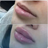 تزریق ژل و بوتاکس جشنواره|خدمات آرایشگری و زیبایی|تهران, عبدل‌آباد|دیوار