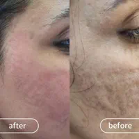 درمان همیشگی تورفتگی پوستی/ جای جوش/اسکار/سالک|خدمات آرایشگری و زیبایی|اصفهان, احمدآباد|دیوار