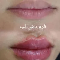 ژل لب گونه،بوتاکس،فیلر بادی صرفا توسط پزشک|خدمات آرایشگری و زیبایی|اهواز, کیانپارس |دیوار