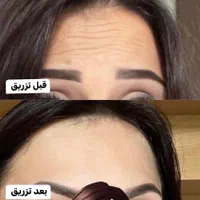 تزریق ژل بوتاکس لیفت نخ هایفو بلفاروپلاستی لیزر|خدمات آرایشگری و زیبایی|مشهد, کوه سنگی|دیوار