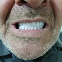 دندانسازی محمدی/طرح کامپوزیت|خدمات آرایشگری و زیبایی|محمدشهر, جعفرآباد|دیوار