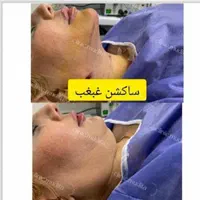 بوکالفت/ساکشن غبغب/ساکشن شکم/تزریق چربی باسن/فیلر|خدمات آرایشگری و زیبایی|تهران, صادقیه|دیوار