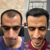 کاشت مو وابرو وریش(نقد واقساط ) اقساطی|خدمات آرایشگری و زیبایی|شیراز, بعثت|دیوار
